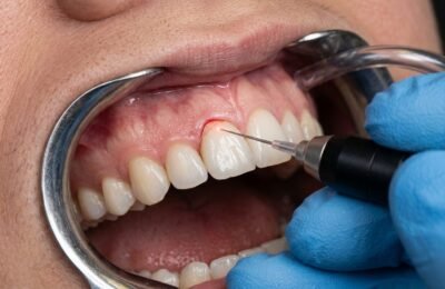 High-Power Diode Lasers in Soft Tissue Surgery: Thermal Boundaries and Hemostatic Wound Healing